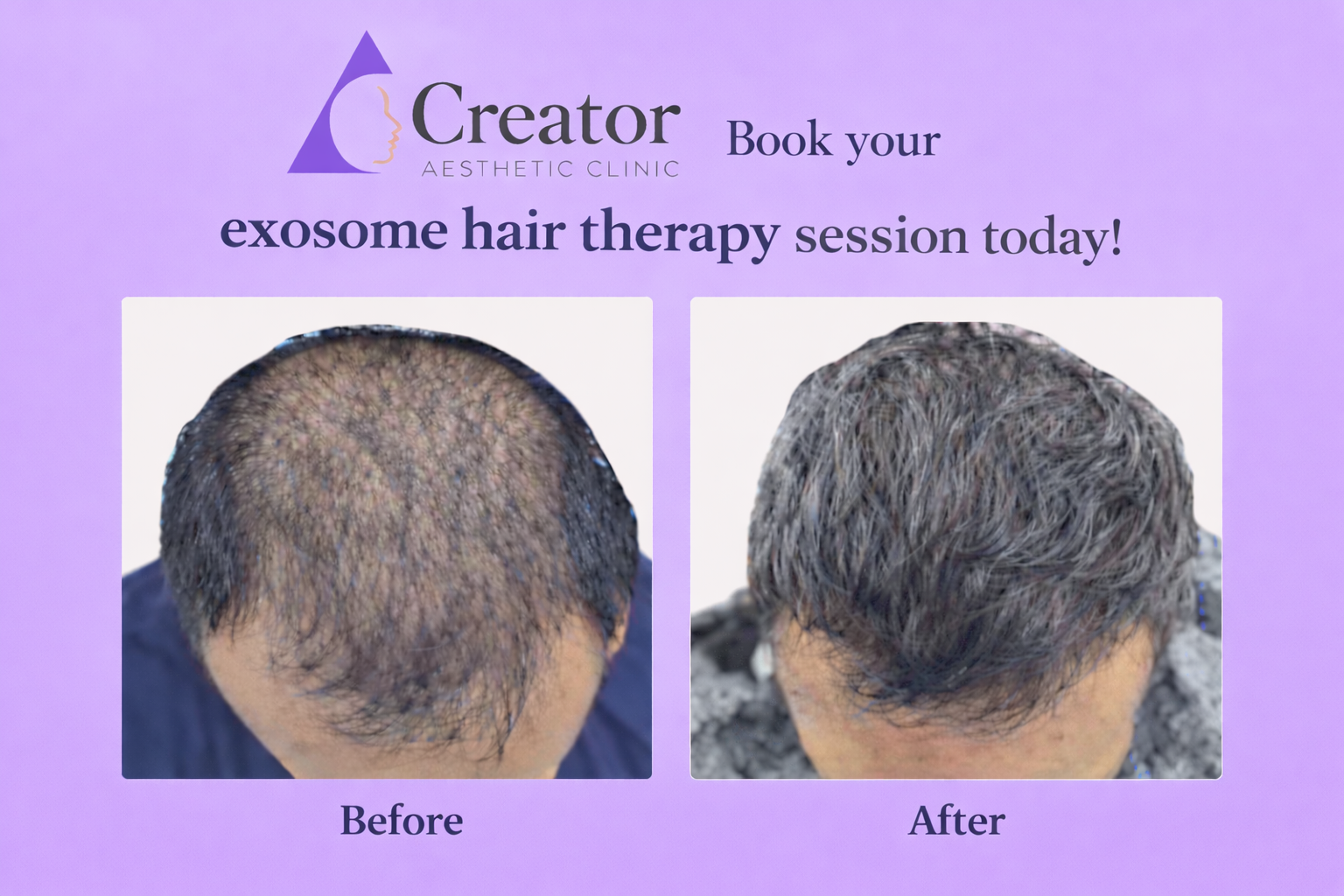 Exosome Hair Therapy result