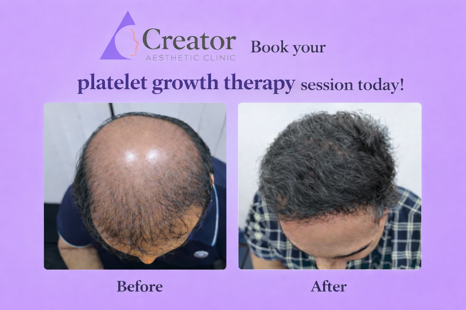 Platelet Growth Therapy result